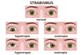 Varieties of strabismus. Eye disease infographic. Royalty Free Stock Photo
